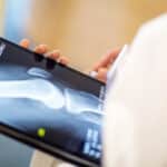 Scientific Breakthrough Identifies Potential Path to Reverse Osteoporosis